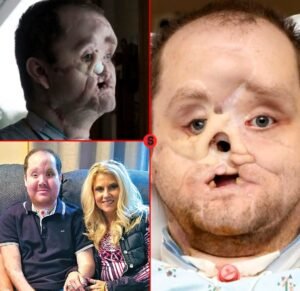 After 58 Surgeries, Derek Pfaff Received a New Face  and a New Chance at Life - photo 226