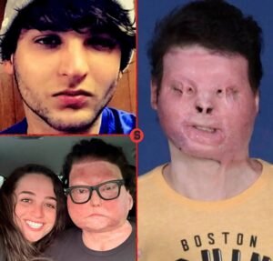 He Survived Burns Over 80 of His BodyThen Became the First Person to Receive a Face and Hand Transplant - photo 216