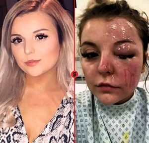 She Was Blinded in One Eye After Eggs Exploded in the Microwave A Terrifying Kitchen Accident - photo 212