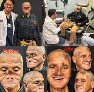 He lost much of his nose to cancer, then surgeons rebuilt it using tissue from his own body - photo 53