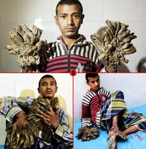 Abul Bajandar The heartbreaking story of Bangladeshs tree man - photo 36