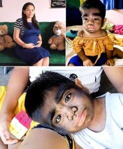 Born With Thick Hair Across His Face and Body, Jarens Story Reveals a Mothers Fear, Love, and Hope - photo 19