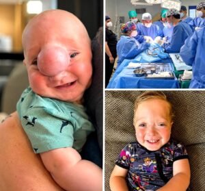 born with a rare skull defect, liam faced an 11-hour operation at just six months oldand kept reaching new mil - photo 9